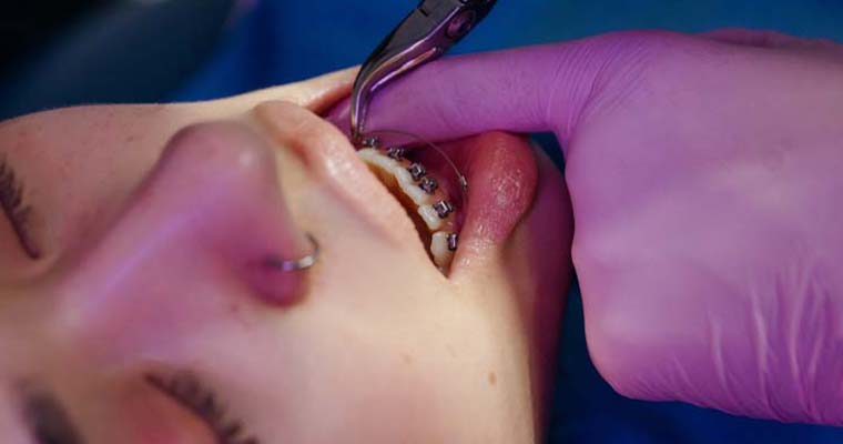 How do I whiten my kids' teeth, how much does a frenectomy cost?