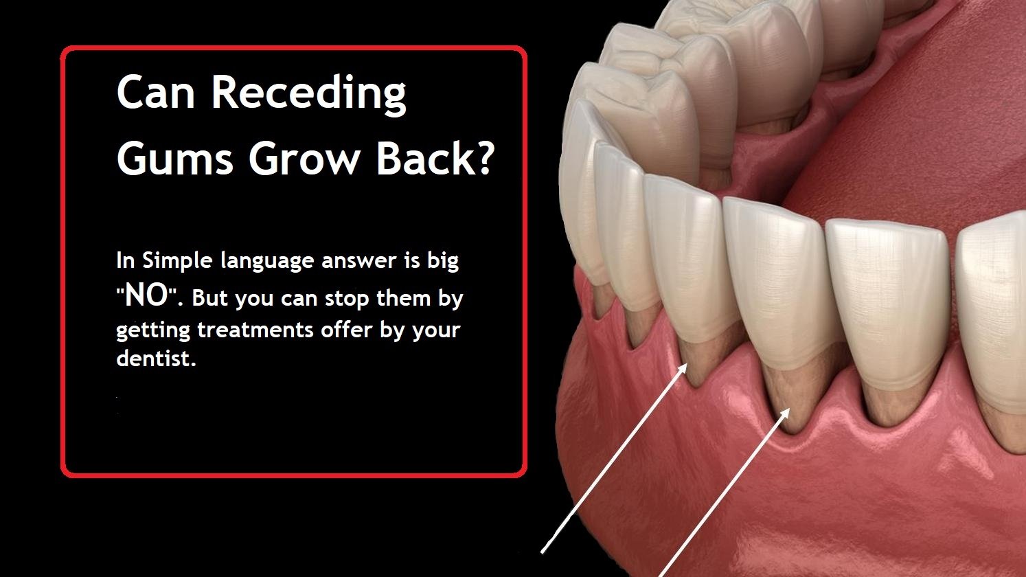 Can Receding Gums Grow Back