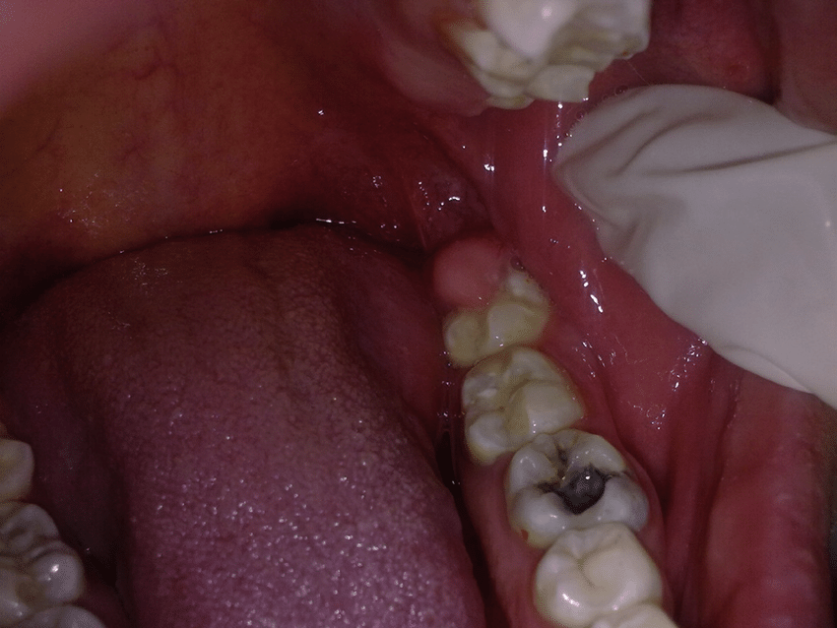 Pericoronitis