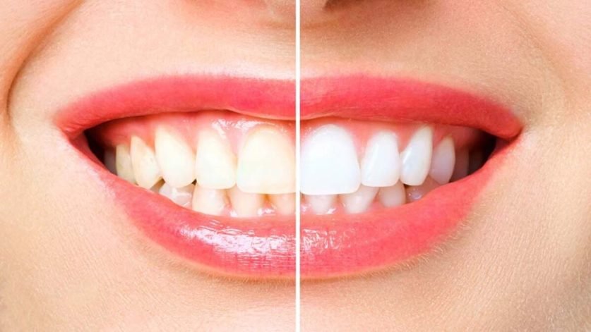 https://www.dentistdiary.com/wp-content/uploads/2022/11/Teeth-Whitening3-e1667294043875.jpg