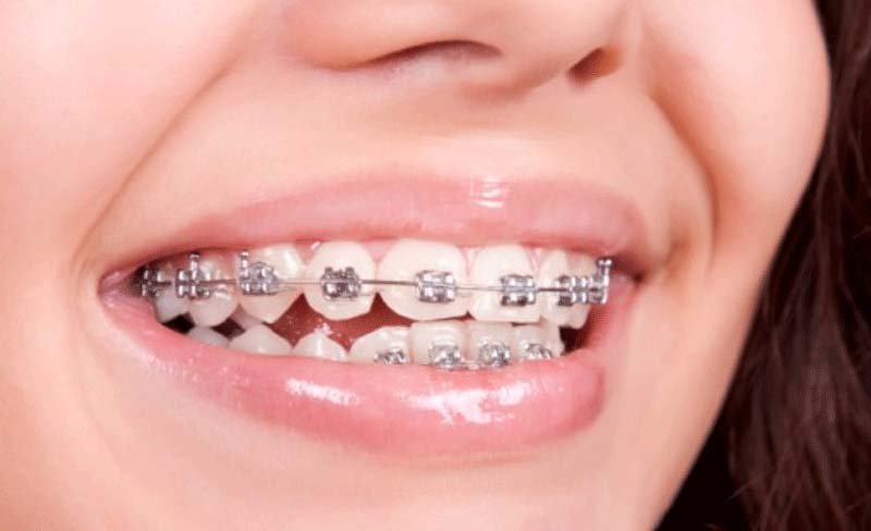 We'll talk about how to take care of your Invisalign, and how your teeth feel.