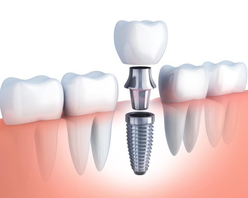 How Do Dentists Determine if a Patient Vapes?